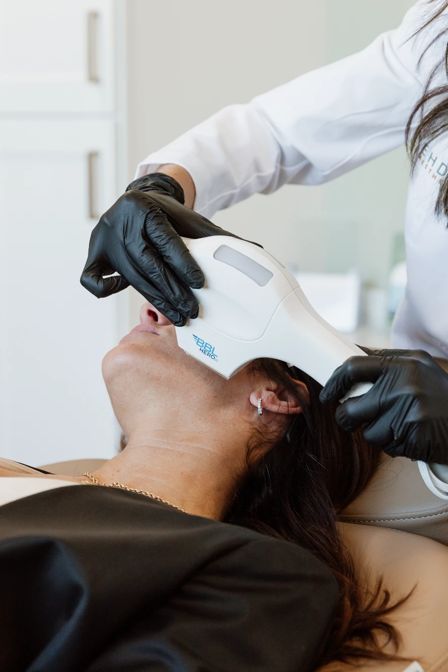 BBL Skin Rejuvenation at Ehden Medical Aesthetics 1