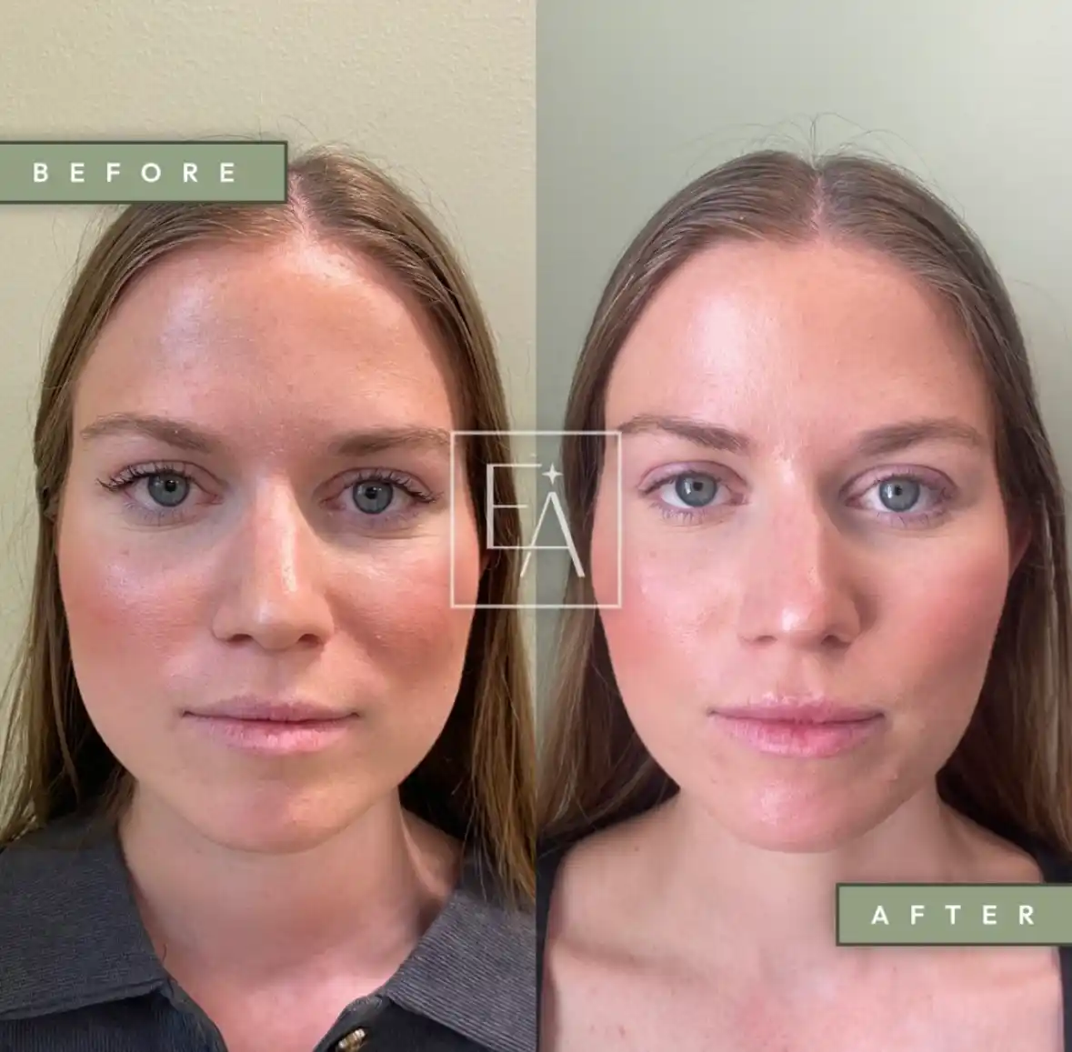 Botox 2