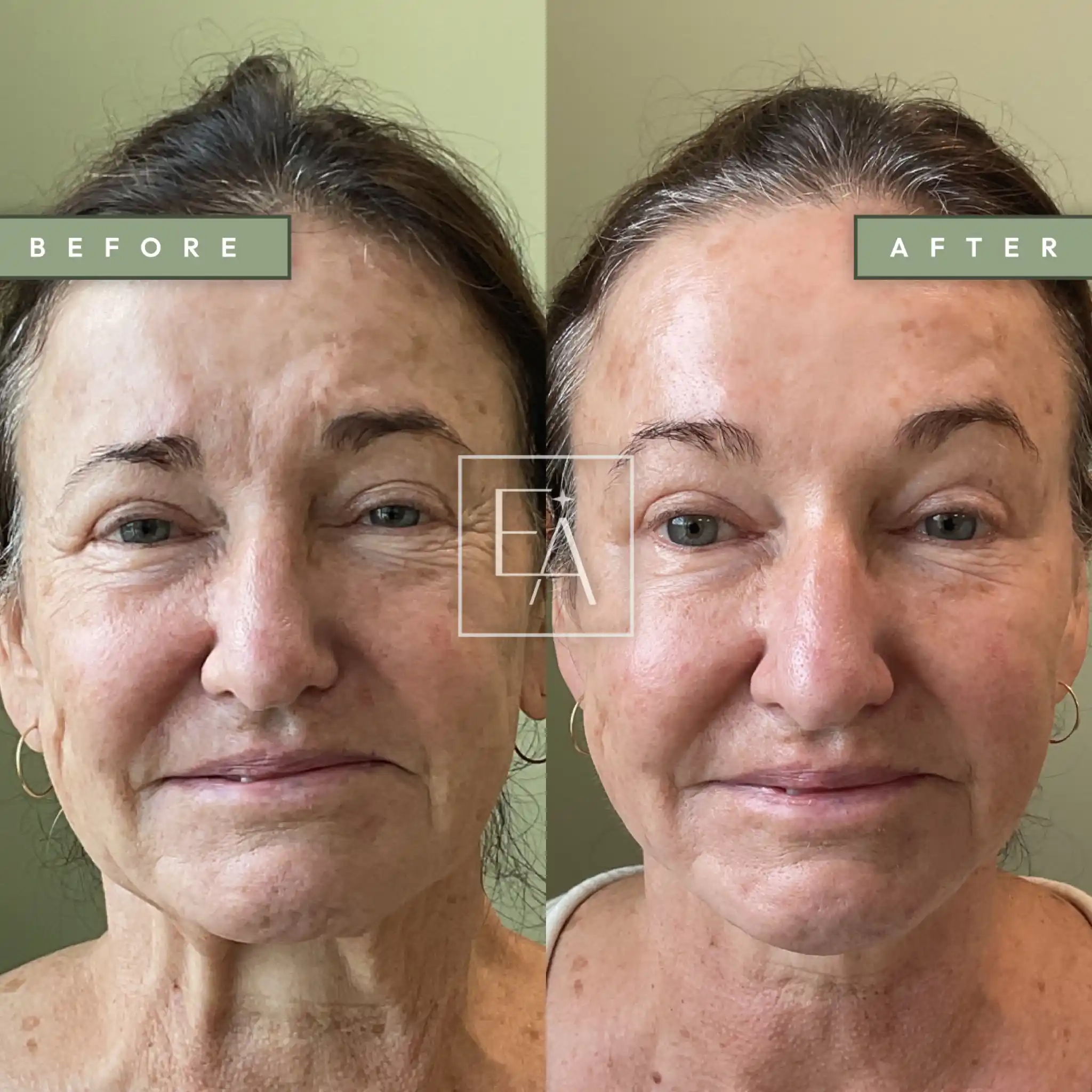 Full Facial Balancing