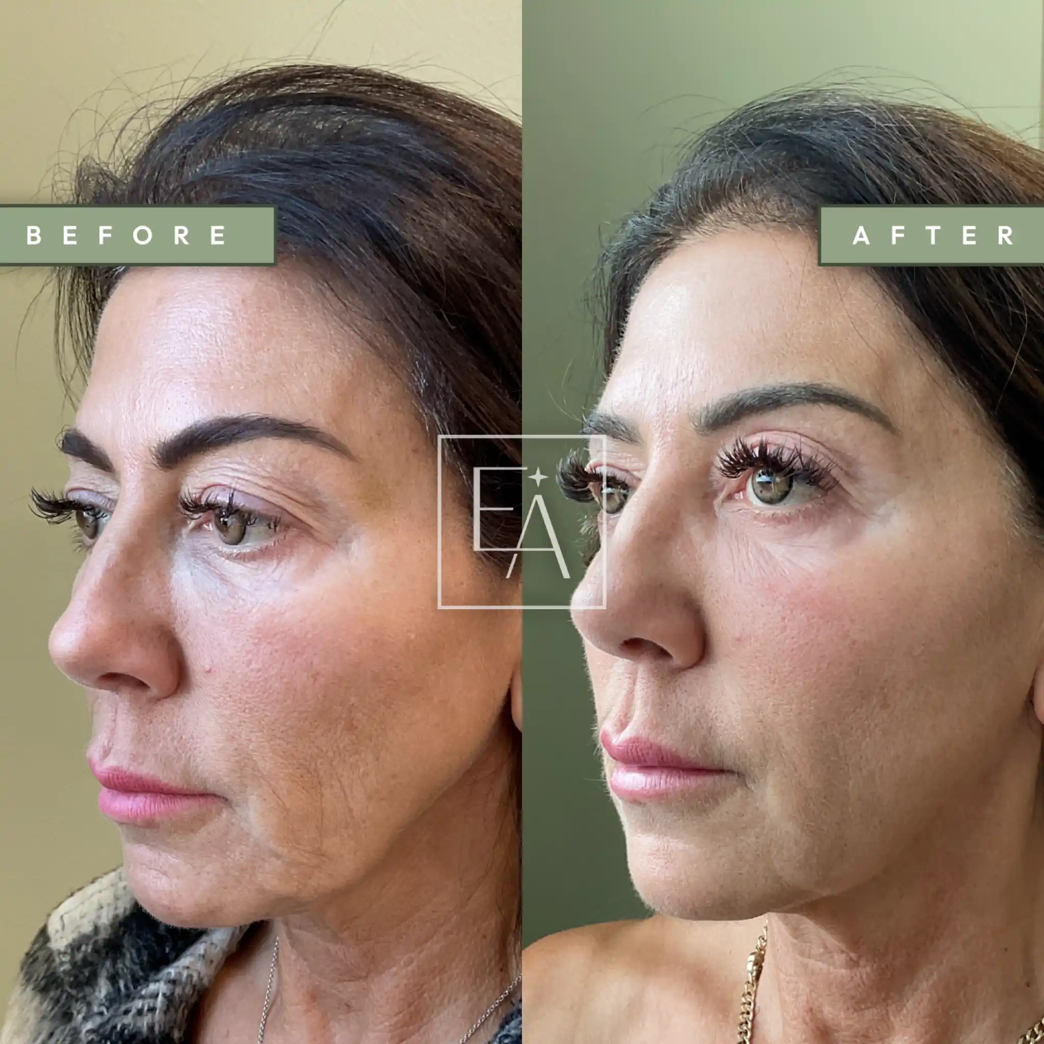 Full Facial Balancing1