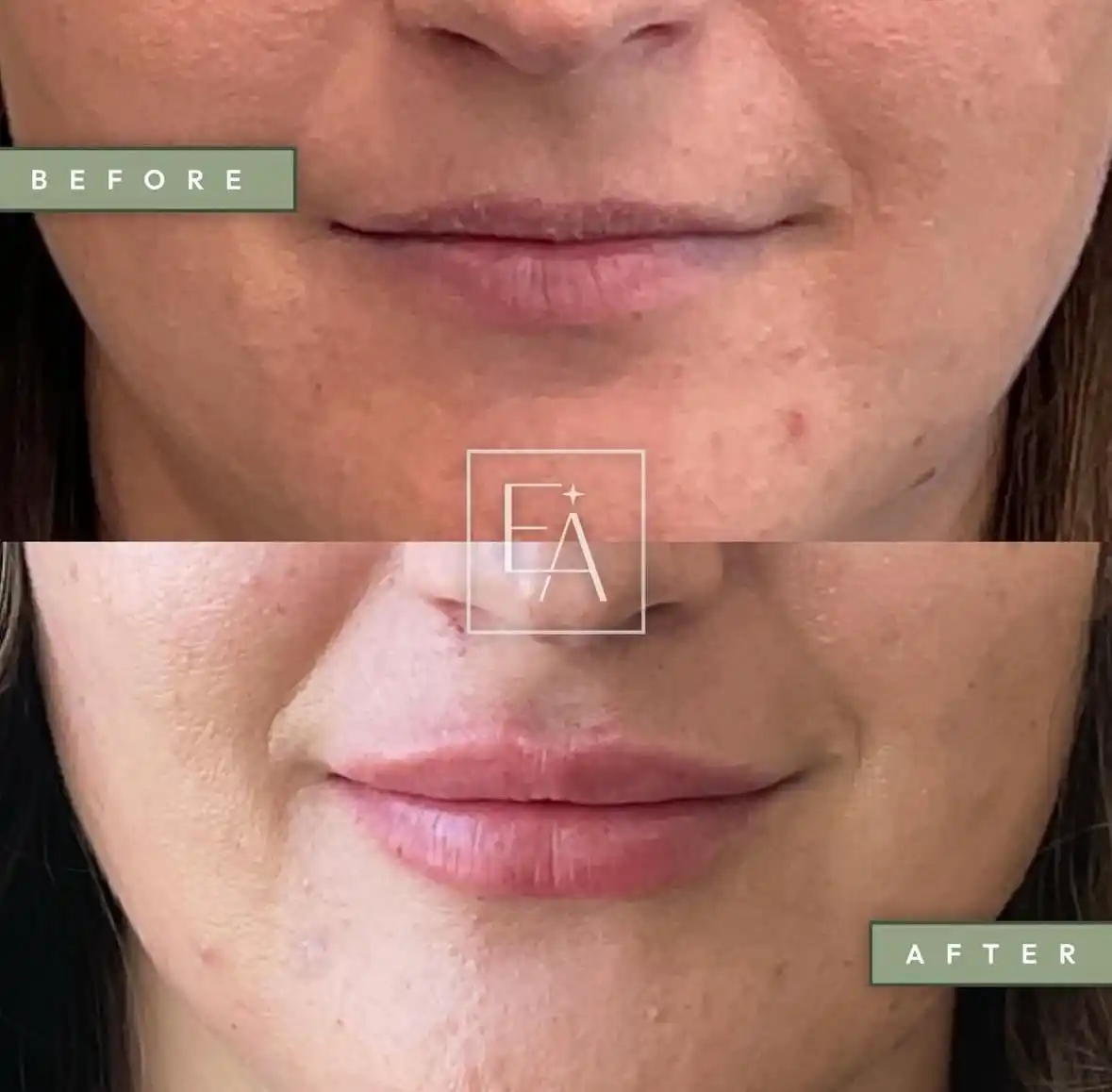 Lip Filler