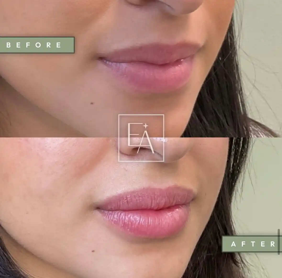 Lip Filler2