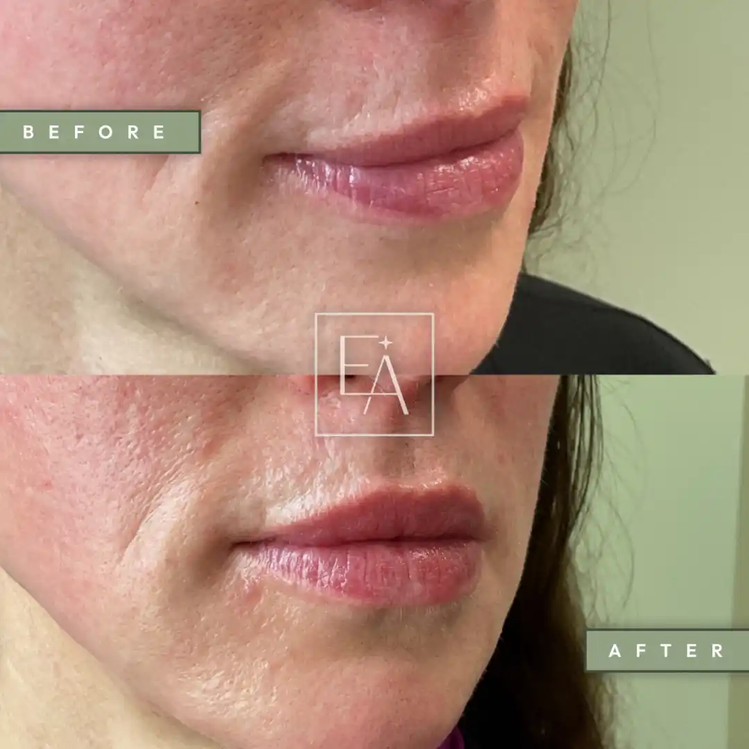 Lip Filler3