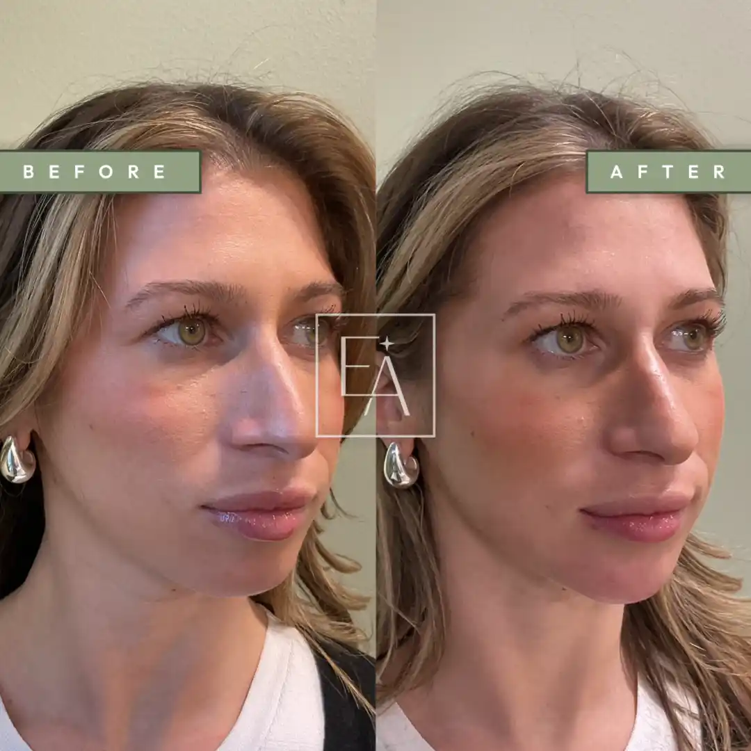 Lower Facial Balancing with Filler