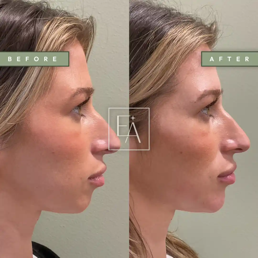 Lower Facial Balancing with Filler 1