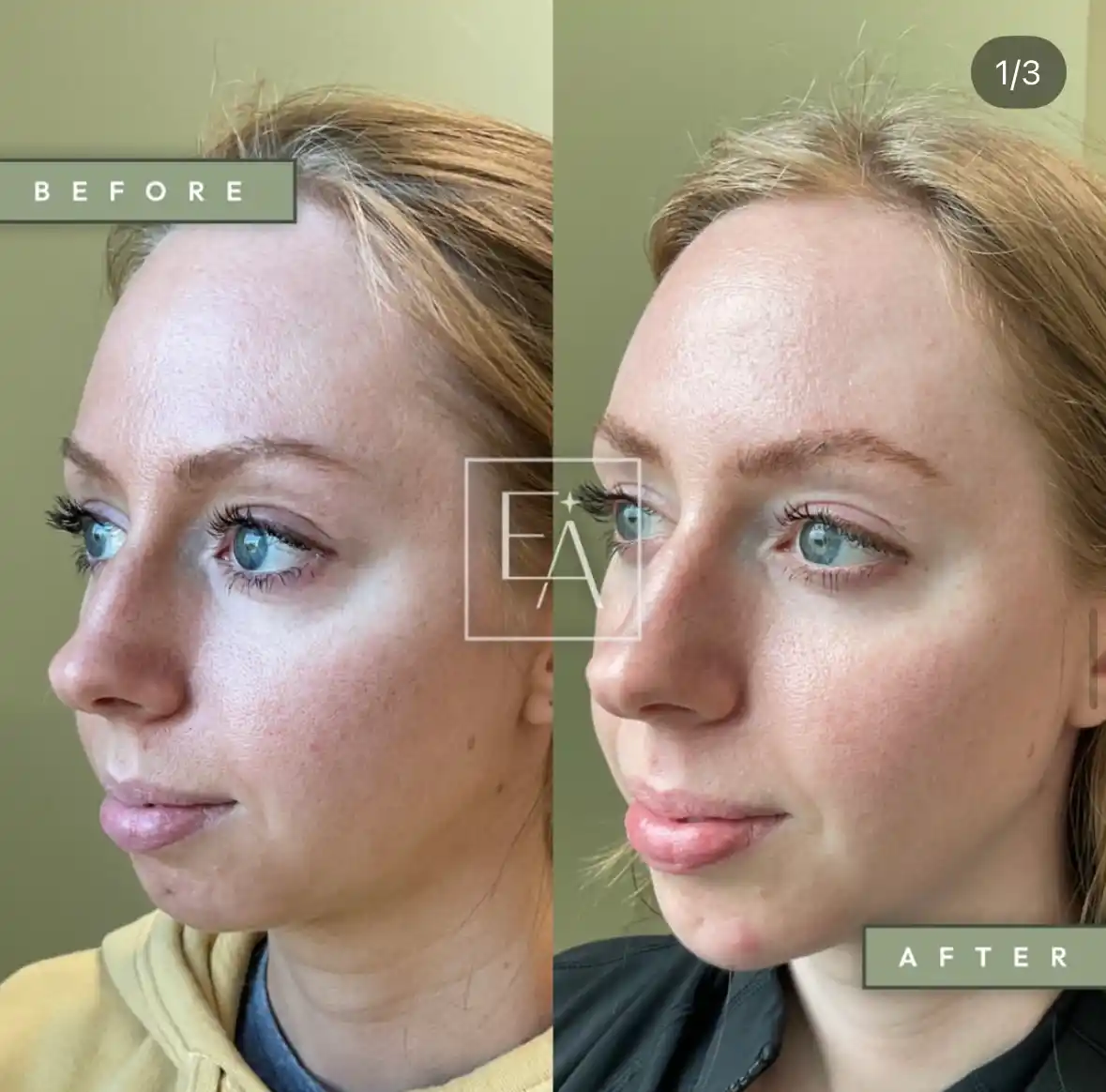 Lower Facial Balancing with Filler 2